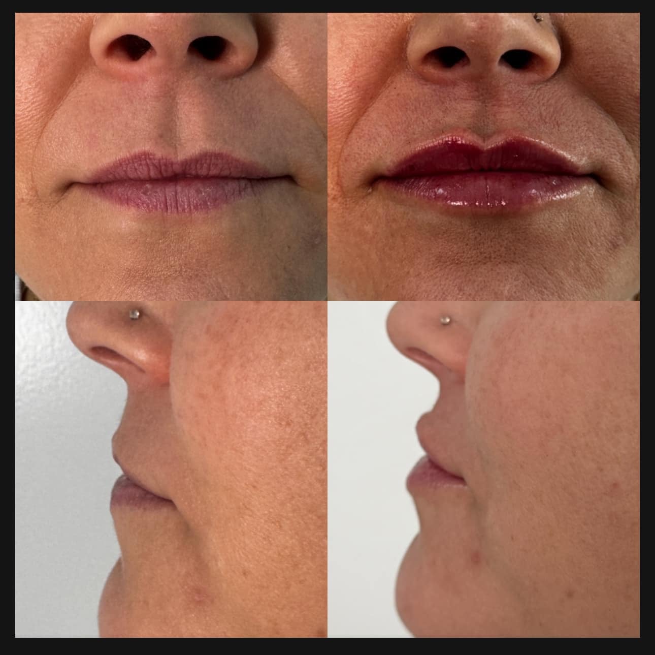 Lip filler patient results in Delaware OH