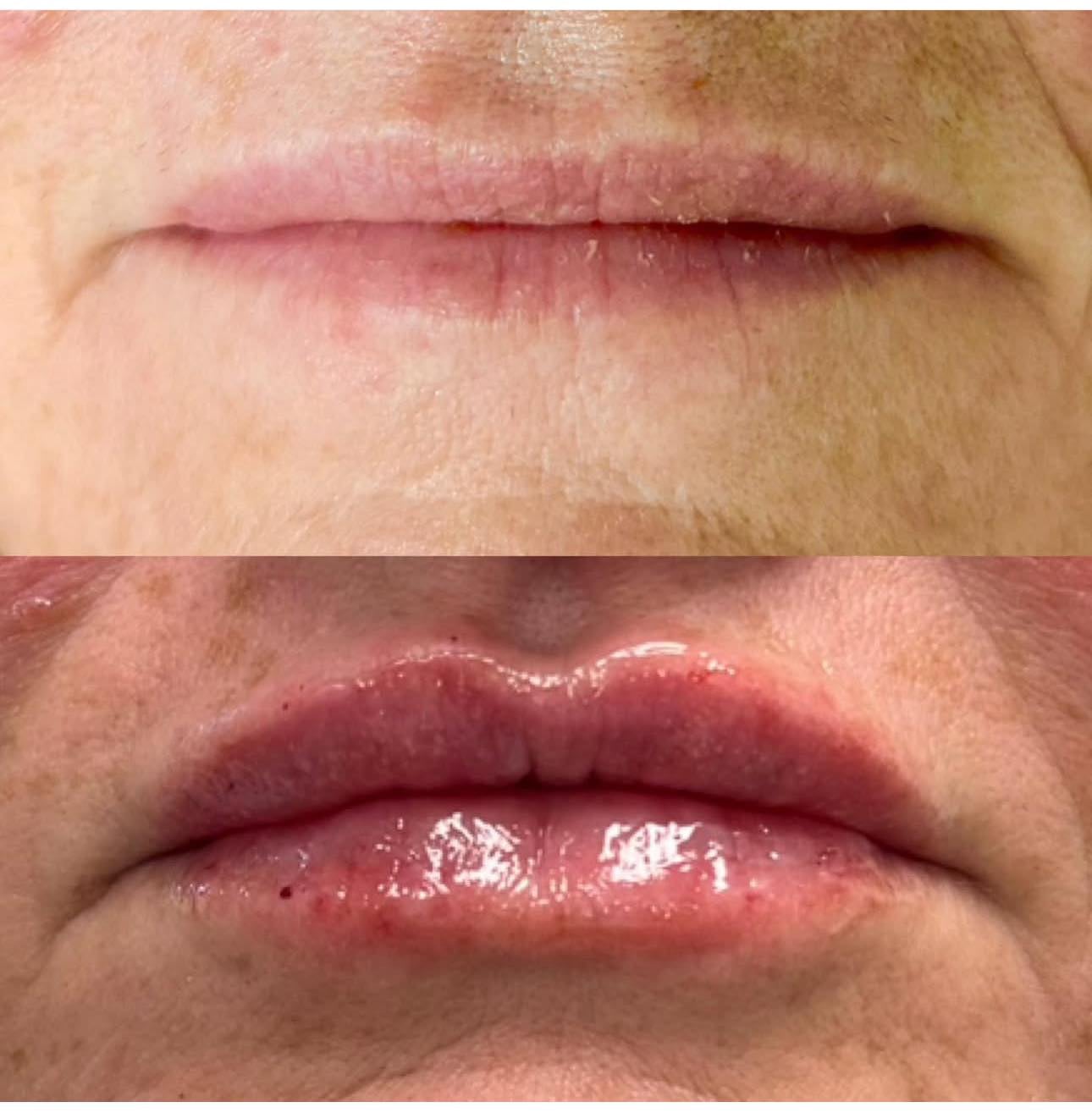 Dysport treatment results at Glow Medical Group