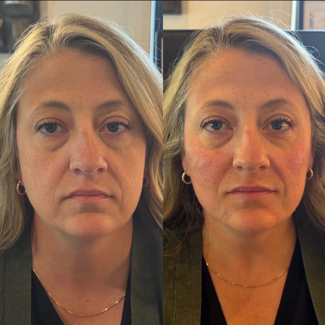 Biostimulator before and after at Glow Medical Group