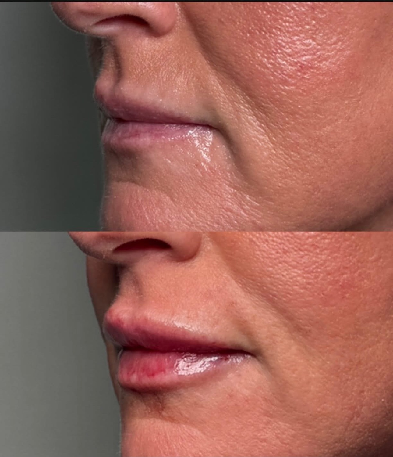 Lip filler before and after at Glow Medical Group