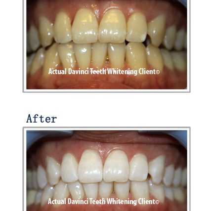 DaVinci Teeth Whitening Before and After - Client 1