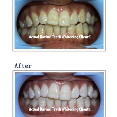 DaVinci Teeth Whitening Before and After - Client 2